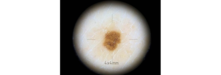 Adapter Dermlite for small areas DL4