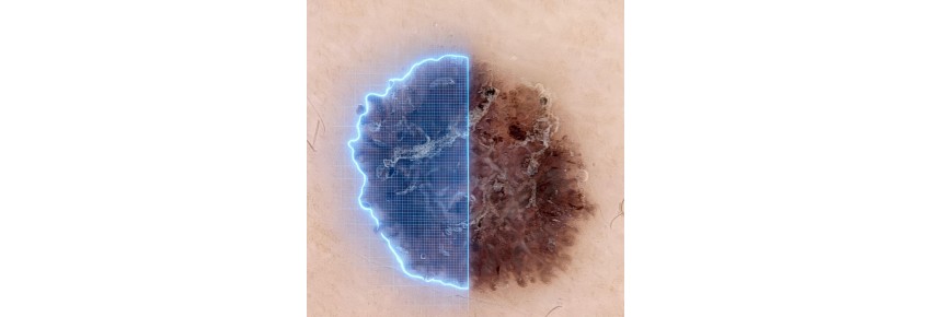 Dermoscopy analysis with artificial intelligence FotoFinder AI