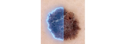 Análisis dermatoscópico con inteligencia artificial FotoFinder AI