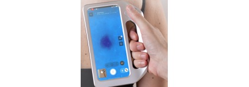 Adquisición de una imagen dermatoscópica con DermLite skeen